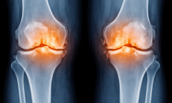 Featured image of post Kniearthrose als Berufskrankheit: Voraussetzungen, Urteil & Chancen für BKF